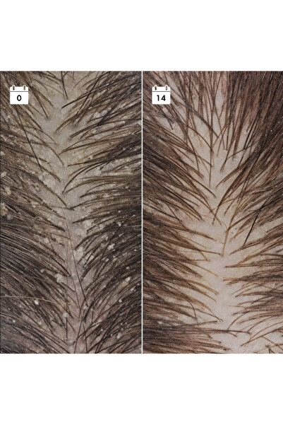 SEPHORA Anti-Dandruff Relapse Prevention Serum - Hair Serum, Relapse Prevention Serum