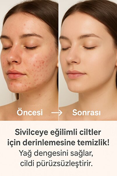 ACM Sebionex Dermatolojik Sabun Yağlı Karma Ciltler İçin Karşıtı Sebum Yüz Vücut Temizleyici