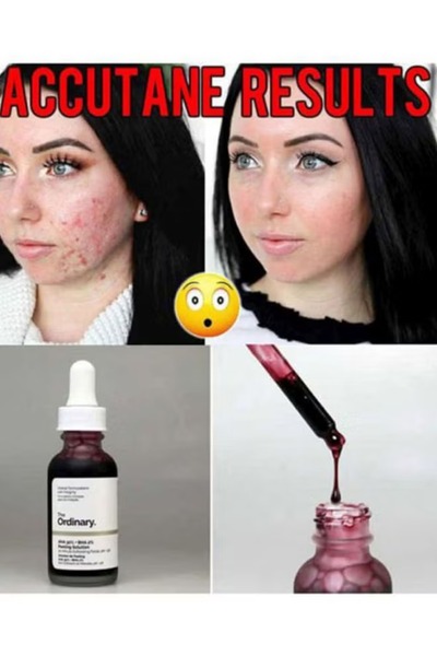 The Ordinary Niacinamide Peeling Serum Set with 10% Niacinamide and 1% Zinc, 2 x 30ml