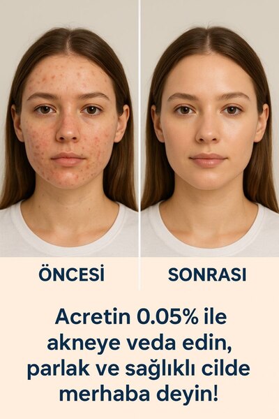 safhas Yuz 0.05 % Cream Acretin Face 0.05 % Cream Acne Treatment Blackhead, Blemish and Skin Renewal