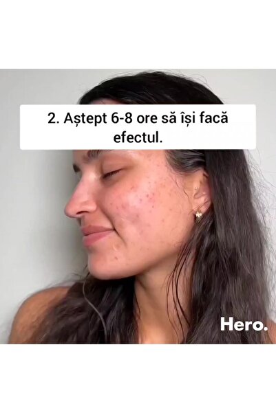 Hero Mighty Patch The Original Acne Hydrocolloid Patches for Whiteheads, 24 Pieces