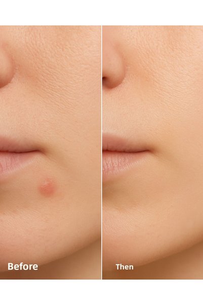 StopEver لاصقة Clearly Spot Patch 24 Pack I هيدروكولويد، محتوى نياسيناميد مضاد لحب الشباب / لاصقة