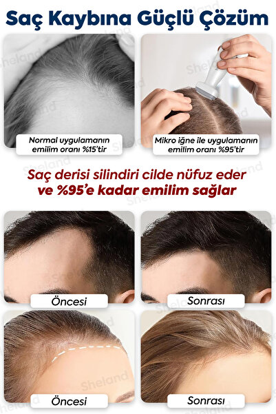 Sheland 120 Titanyum İğneli Ayarlanabilir İğne Ölçülü (0.25-2.0mm) Dermastamp Derma Stamp Dermaroller Roller