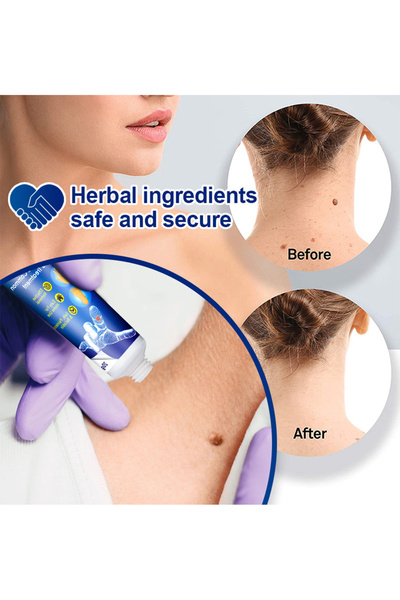 SUMIFUN Wart Remover Ointment Cream Skin Tag for Common Treatment Effective Safe