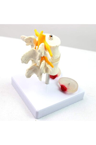 EgeAnatomi Maketleri Fıtık ve Disk Kayması Olan 2 Lomber Vertebralı Omurga Modeli - Omurga Maketi