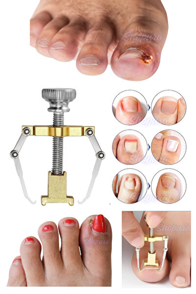 Shopura Batık Tırnak Çıkartıcı Ayak Tırnak Batması Düzeltici Pens Aparat