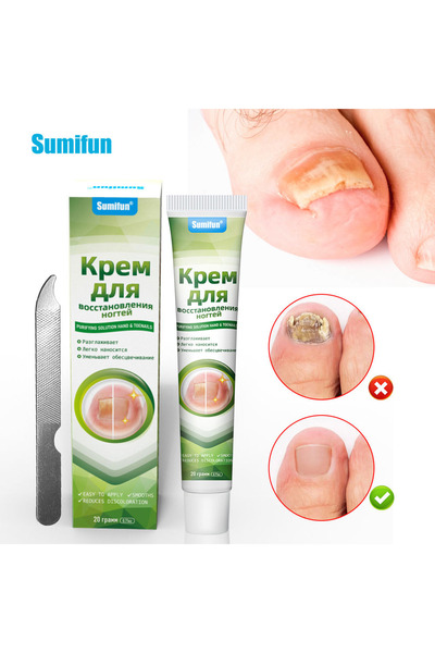 SUMIFUN كريم جديد لعلاج فطريات الأظافر وأصابع القدمين وجل لعلاج فطريات الأظافر