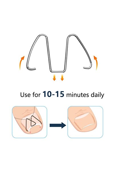 KESNUP Set de 6 corectoare pentru unghii încarnate și 30 de benzi elastice, a...