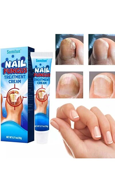 SUMIFUN كريم علاج فطريات الأظافر يعزز نمو الأظافر ويحسن مظهر الأظافر المتقدمة في السن ويغذيها
