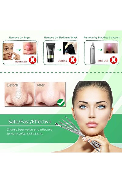 NEO Set of 5 tweezers for extracting blackheads, acne, comedones, Nybgyy, stainless steel, silver