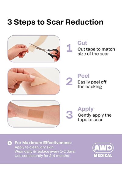 AWD Medical 100% Soft Silicone Gel Tape (1.6" x 60") Highly Comfortable Painless 6-8 Month Supply Ac