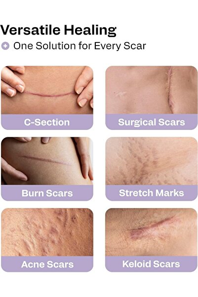 AWD Medical 100% Soft Silicone Gel Tape (1.6" x 60") Highly Comfortable Painless 6-8 Month Supply Ac