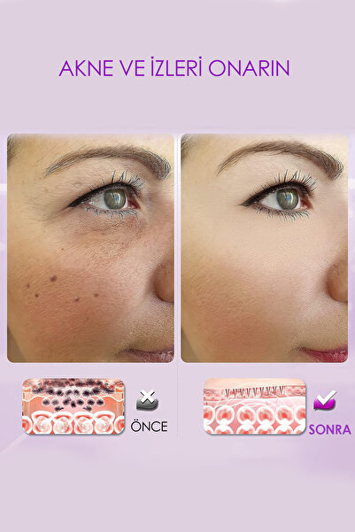 Beatitude Dermaroller Siyah Roller Titanyum iğneli Masaj Aleti Saç Tarağı