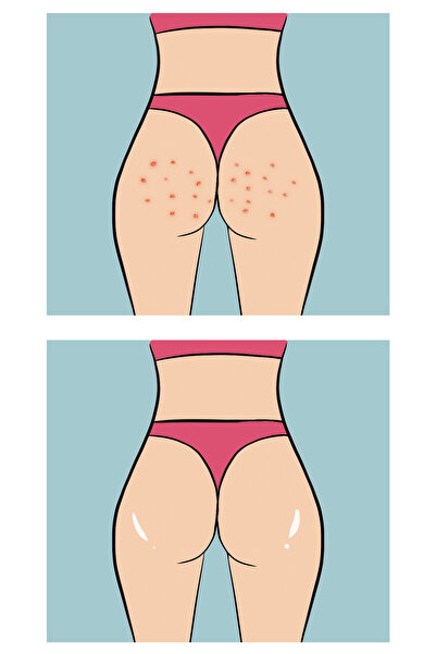 Skin Sensual Buttoks Buttne Body Mask |   Against Body Acne and Roughness |   2 Pieces