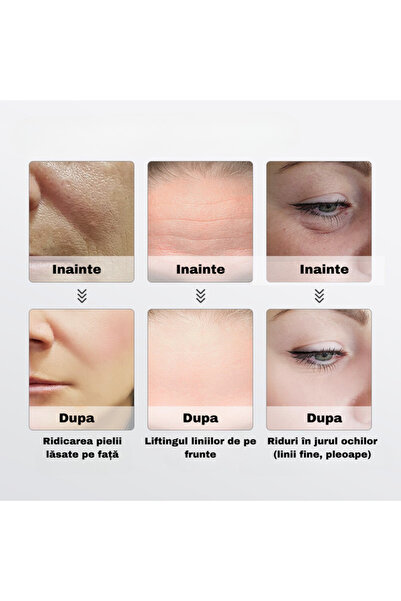 MARCINO Beauty Device,Facial Treatment,Skin Care,Face Lifting,Mesotherapy,Red Light,Acne