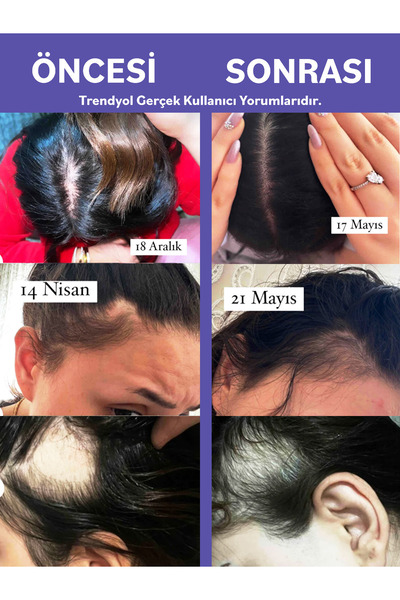 Radix Saç Dökülmesine Karşı Serum Sprey (%5 Procapil) - Anti Hair Loss Lotion 60ML