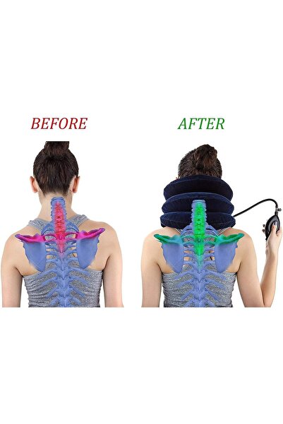 Generic Cervical Neck Traction Device Inflatable Neck Stretcher (Blue) - RUNZI