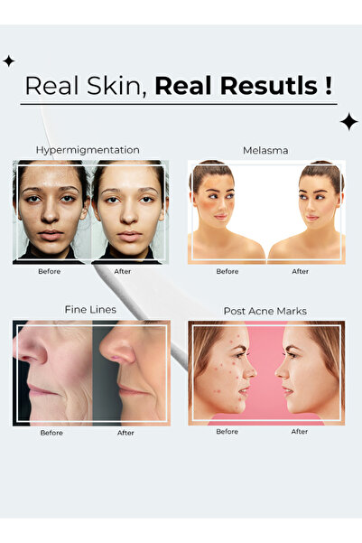 Muna Belleza Dark Spot Remover Face Cream Set - Melasma, Freckles, Sun Spots, Anti-Wrinkle, Day & Night