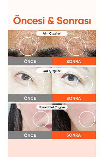 ACROPASS Retinol ve PDRN Mikro İğneli Göz Altı ve Nazolabial Çizgi Reti-rn Microcone Patch Slim 6’lı