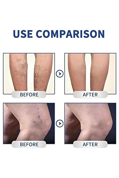 Zenorius Cremă pentru varice Varicose Veins – reducerea venelor vizibile și îmbunătățirea circulației, 20g