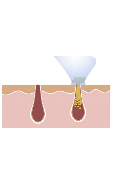 MANDU Derma Suction facial device Vacuum skin cleanser