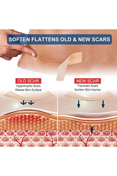 SKY TOUCH ZODENIS Silicone Scar Sheets 1.6" x 120" Roll (3M) - Silicone Scar Tape, Reusable