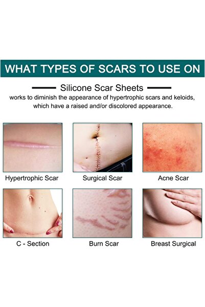 SKY TOUCH ZODENIS Silicone Scar Sheets 1.6" x 120" Roll (3M) - Silicone Scar Tape, Reusable