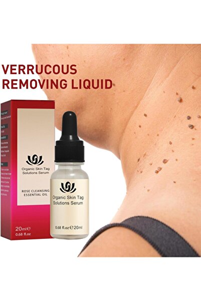 EELOHE 5 Pc Essential Oil Mole and Wart Remover, Natural Herbal Extract, 20 ml