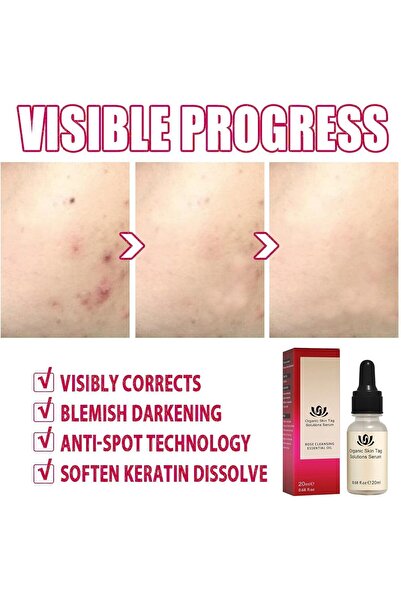 EELOHE 5 Pc Essential Oil Mole and Wart Remover, Natural Herbal Extract, 20 ml