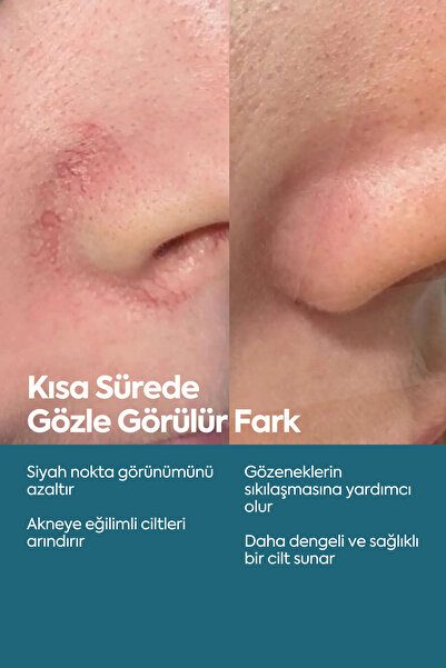 Clasy Care Siyah Nokta Ve Karşıtı, Önleyici Serum, Niasinamid Ve Çinko