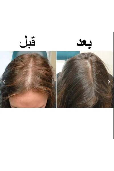 Becave استعادة الشعر – أفضل علاج لتساقط الشعر