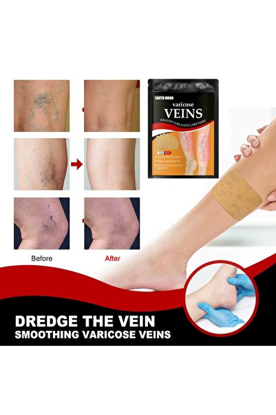 Varicose Veins Pachet Îngrijire Picioare – Cremă pentru Varice + Plasturi Varicose Veins, Confort și Îngrijire
