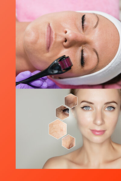 pp405 540 İğneli Titanyum Dermaroller - Saç ve Sakal Serumu Uygulama Cihazı 1,mm