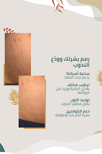 Clasy Care كريم ممتاز لتقليل ظهور الندبات وعلامات التمدد والوقاية منها
