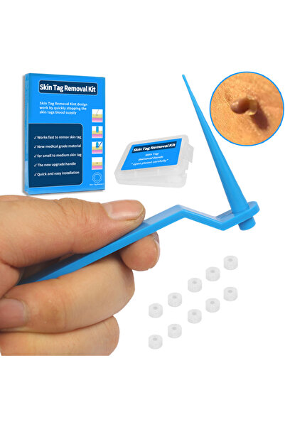 Choice قلم إزالة الثآليل الأزرق المحمول غير المؤلم، ملصق جلدي لإزالة الثآليل،...