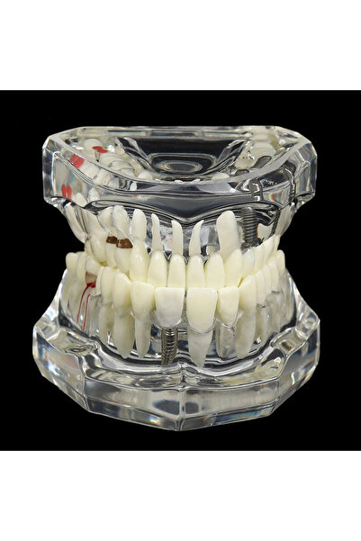 Choice3 transparent Dental Models Removable And Restorable Models Of Diseased...
