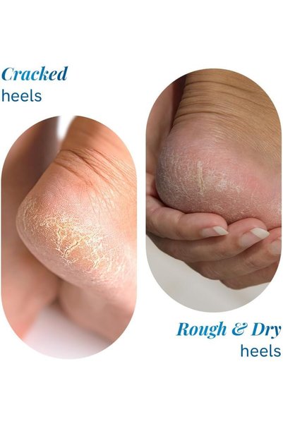 Be Bodywise 20% Urea Foot Cream Roll On | Repairs Dry & Cracked Heels | 75ml