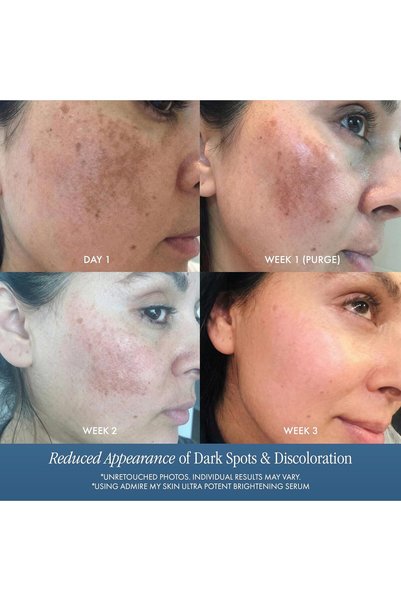 Admire My Skin Dark Spot Corrector Remover - Brightening Discoloration Correcting Serum