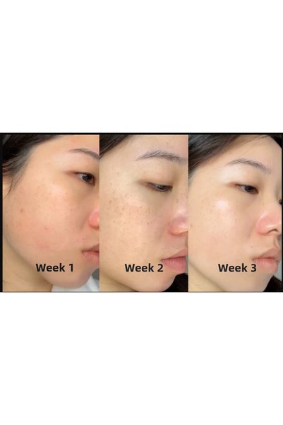 VERANT High Acid Ratio Kojic Acid Soap (Turmeric and Kojic Acid) Anti-Blemish Kojic Acid Soap