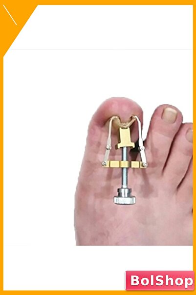 Batık Tırnak Düzeltme Aparatı ile Evde Tedavi Çözümü