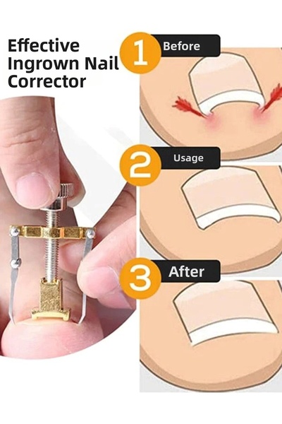 TakÇalıştır أداة إزالة الأظافر المتشابكة الأصلية من الفولاذ، جهاز تصحيح الأظا...