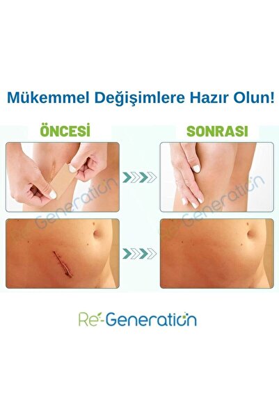 RE-GENERATION Ameliyat izi Giderici Silikon Bant - Yara, Yanık, Ameliyat , Akne izileri için - 9x2x0,1 Cm