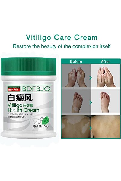 Supwell Vitiligo Cream, White Spot Cream Treatment