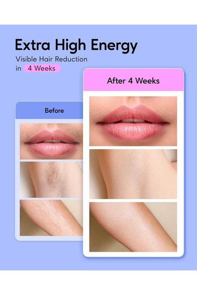 BoSidin Permanent Hair Remover At Home, Upgraded High Energy Levels Laser Hair Removal For Women And Men, 999K Flashes Effective And Safe For Whole Body