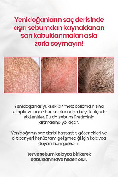 Atopalm Bebeklere&Yenidoğanlara Özel Göz Yakmayan Konak&Sebum Karşıtı Şampuan Newborn Scalp Shampoo