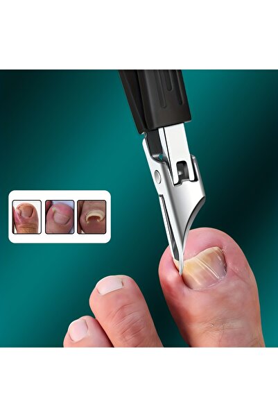 STARSTAR High-Precision Heavy-Duty Stainless Steel Ingrown Nail Clipper with ...