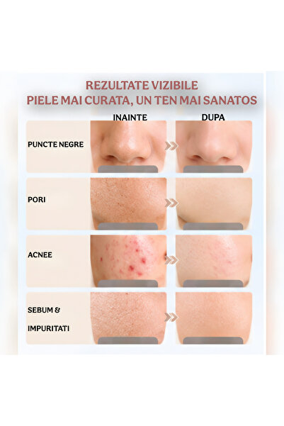 2AMNOVA Aparat profesional pentru curatarea tenului cu ultrasunete, scrubber facial, eliminare puncte negre, exfoliere si lifting, reincarcabil USB