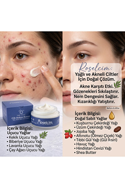 Yağlı ve Akneli Ciltler için Akne Kremi