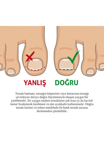 ORVİCA Paslanmaz Çelik Tırnak Batması Engelleyici , Batık Tırnak Çıkartıcı ( 1.7 Cm - 3Cm Arası Uyumlu )