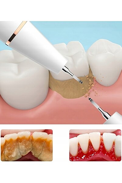 NO BRAND Detartror dentar cu ultrasunete pentru dinți, îndepărtare puternică ...
